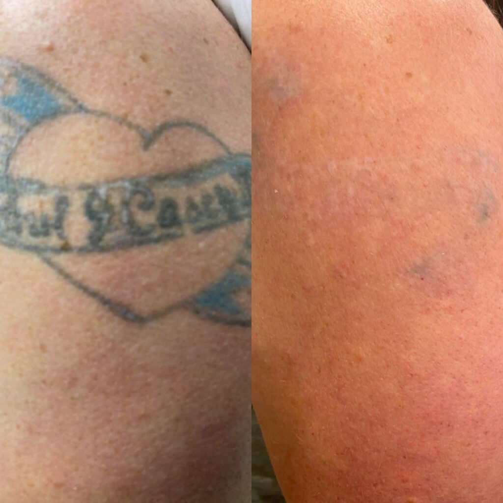 before and after laser tattoo removal