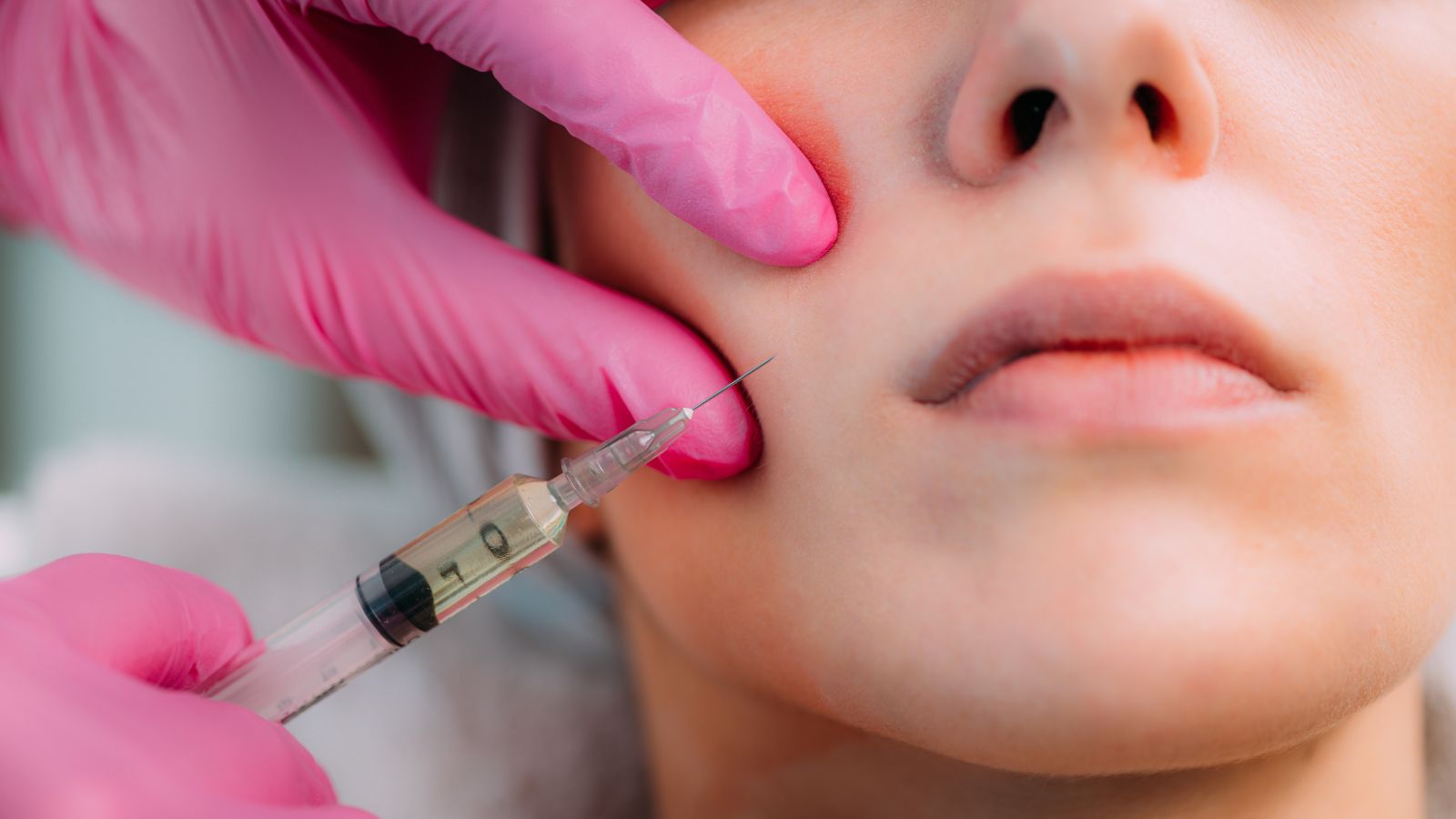 Supra Cheek FIllers Treatment