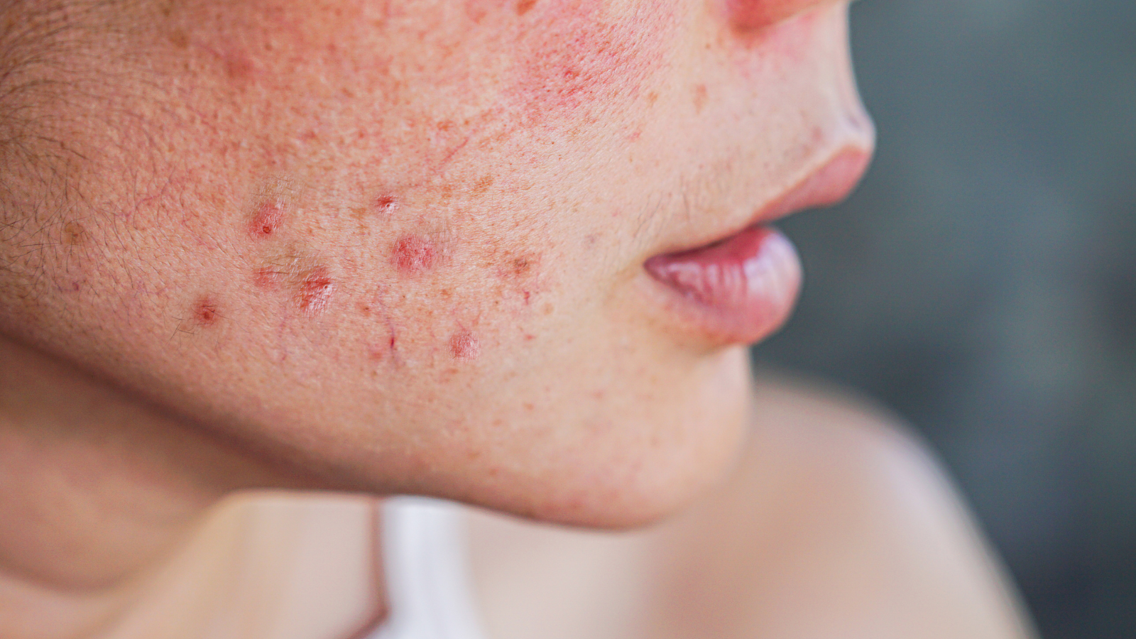 Effective acne treatments ogden utah